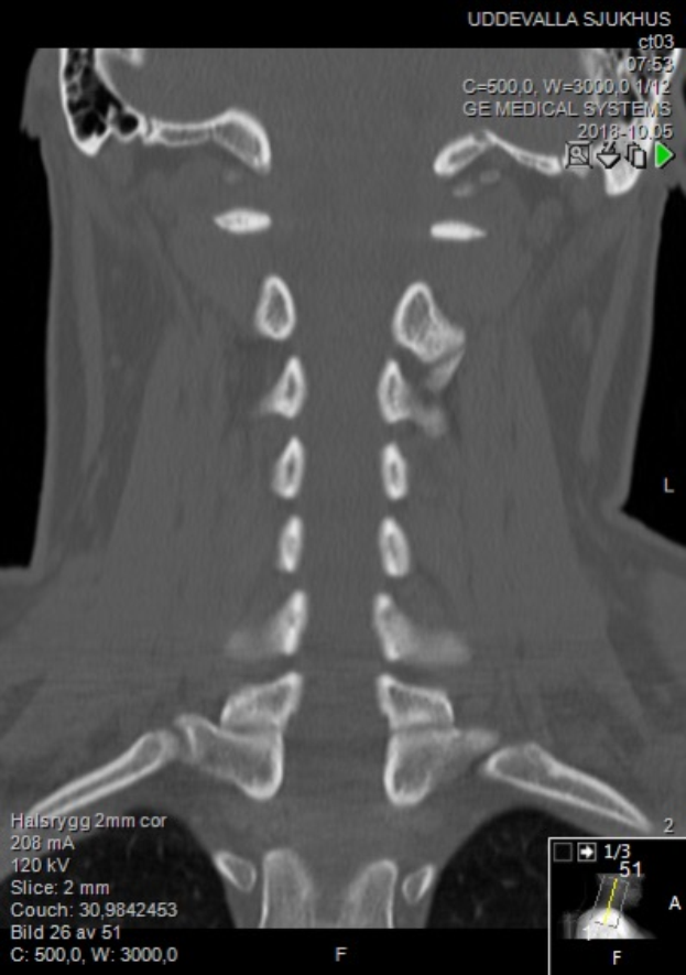 Eine MRT-Aufnahme eines Mannes mit einem Halsbruch, die auf einem Computerbildschirm angezeigt wird.
