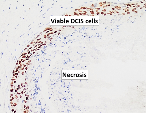 Mikroskopisches Bild eines formalinfixierten Paraffin-Einschnitts eines menschlichen Gewebes, das DCIS-Zellen und Nekrose zeigt, gefärbt mit Anti-cdc1-Antikörper und BSA.